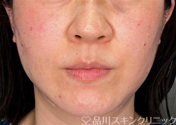 症例NO.59132のAFTER写真