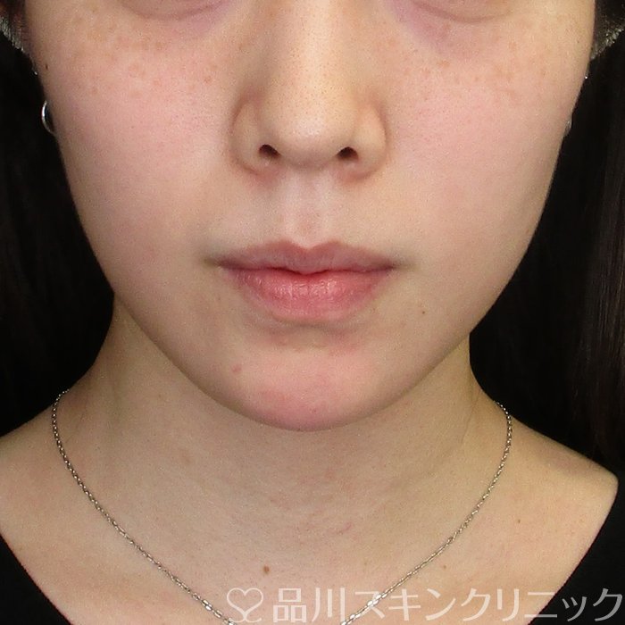 症例NO.74438のAFTER写真