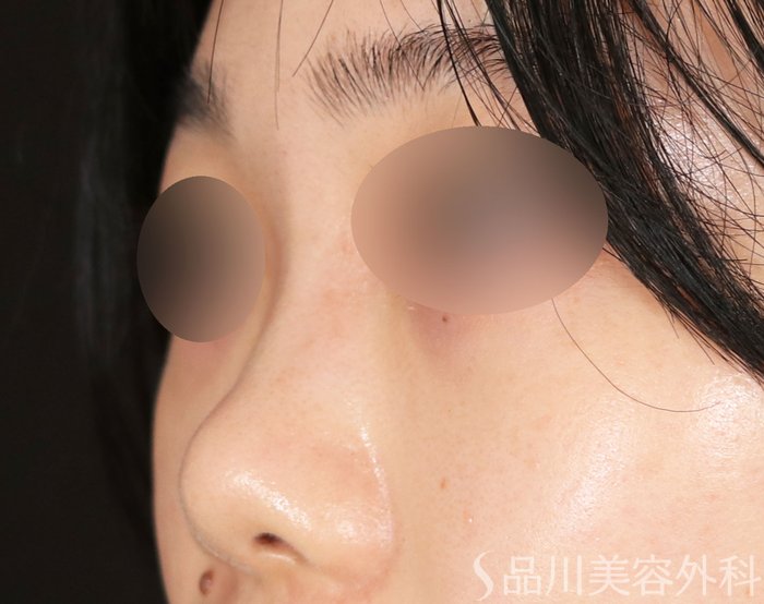 症例NO.71741のBEFORE写真