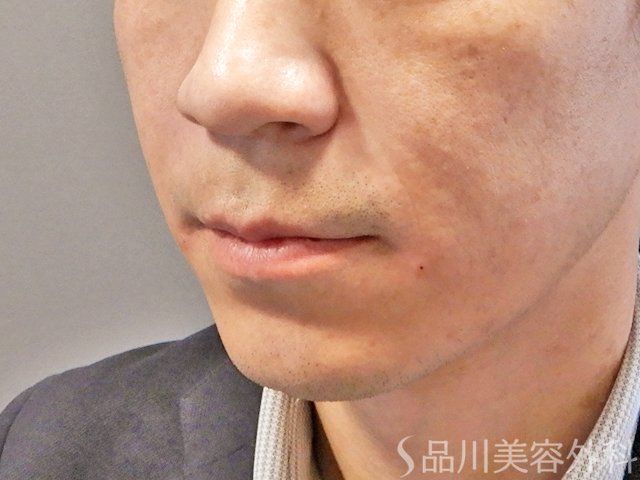 症例NO.68334のAFTER写真