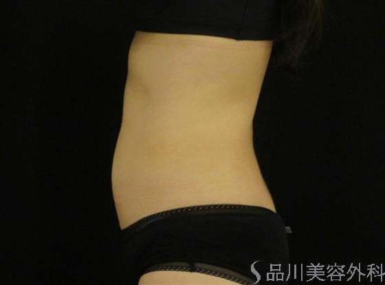 症例NO.49416のAFTER写真