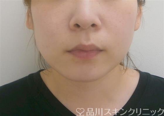 症例NO.37364のBEFORE写真