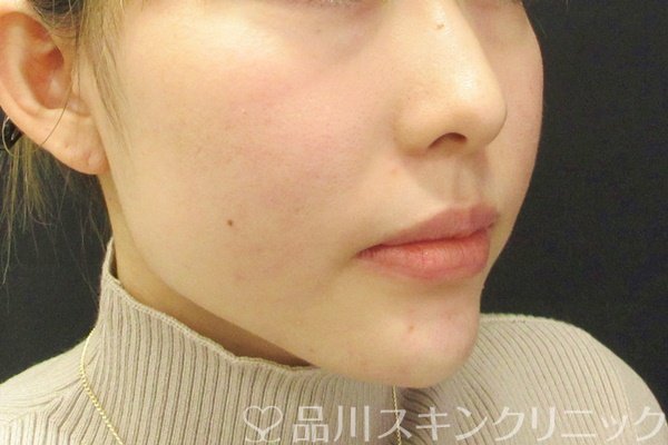 症例NO.68365のAFTER写真