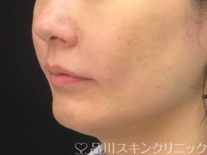 症例NO.70600のAFTER写真