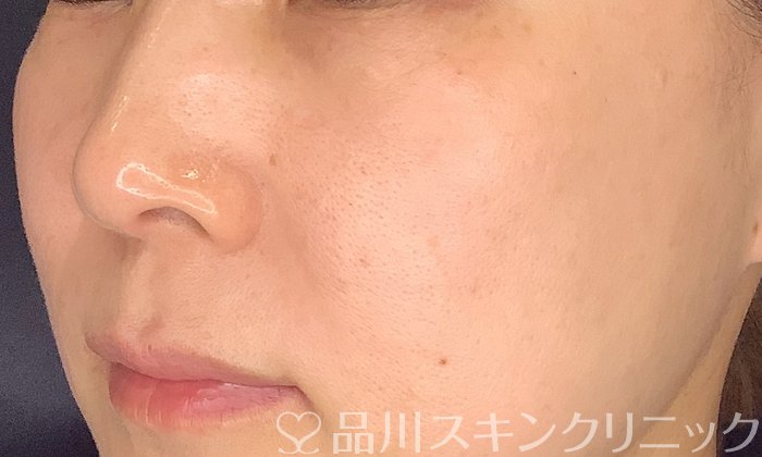 症例NO.73718のAFTER写真