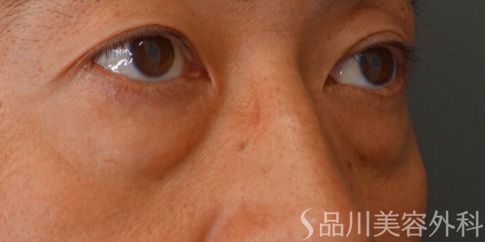 症例NO.62219のBEFORE写真
