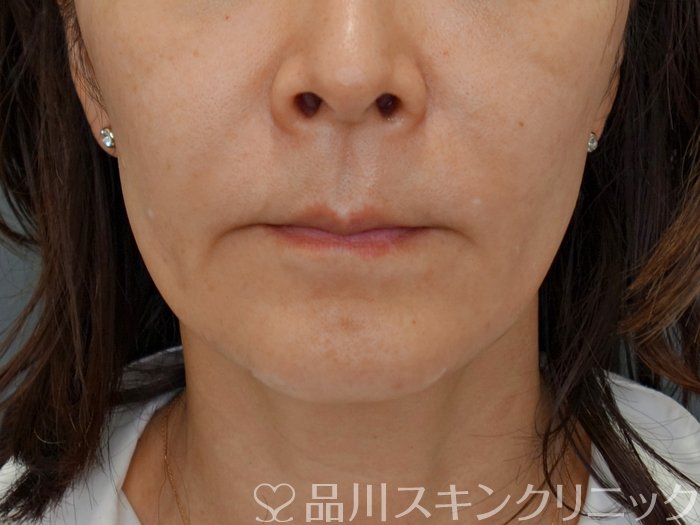 症例NO.71752のBEFORE写真