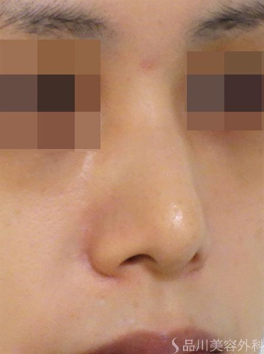 症例NO.39186のAFTER写真