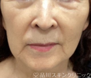 症例NO.71143のBEFORE写真