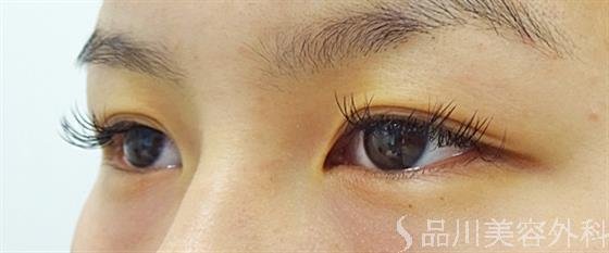 症例NO.34443のBEFORE写真