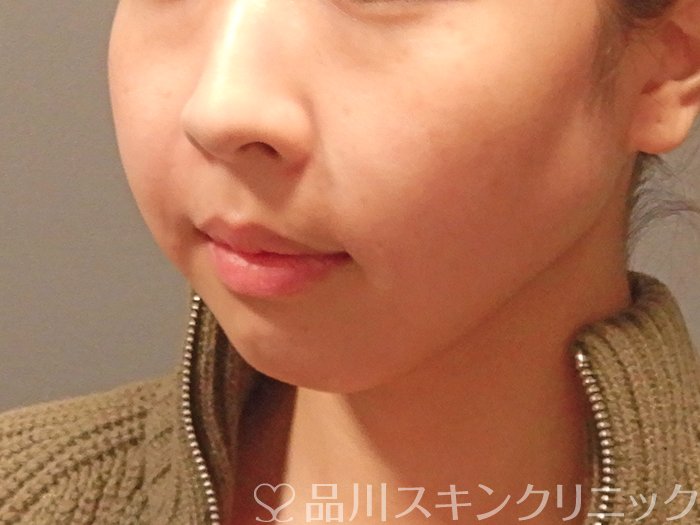 症例NO.63155のAFTER写真