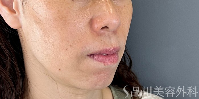 症例NO.72835のAFTER写真