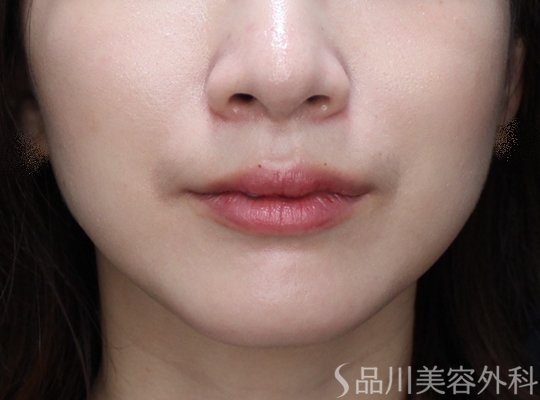 症例NO.73825のAFTER写真