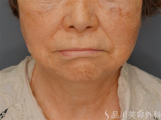 症例NO.59823のAFTER写真