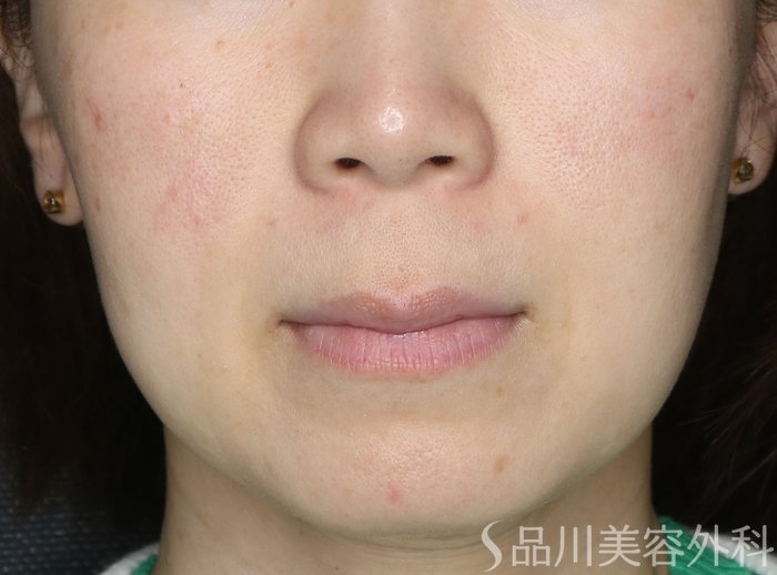 症例NO.72162のAFTER写真