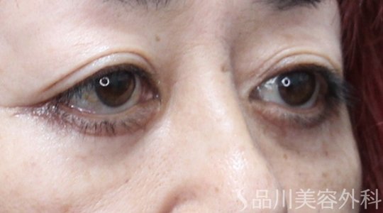 症例NO.71148のAFTER写真