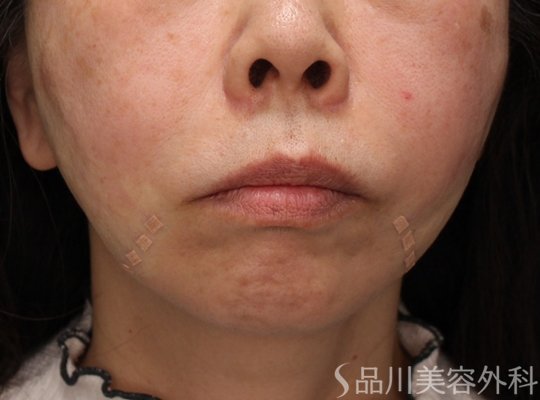 症例NO.72432のAFTER写真