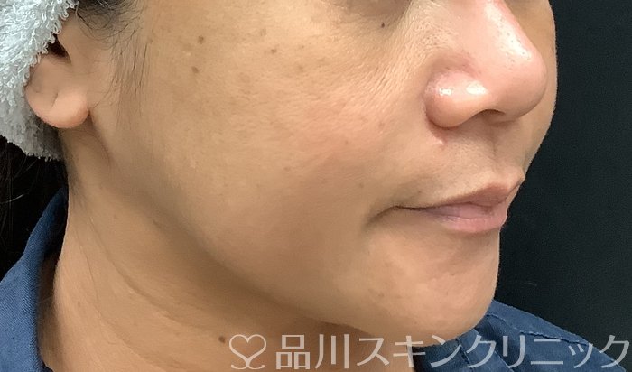 症例NO.69378のBEFORE写真