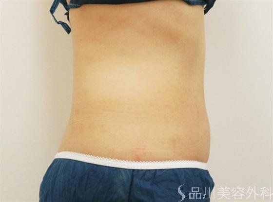 症例NO.17333のAFTER写真