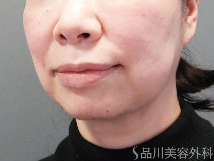 症例NO.73373のBEFORE写真