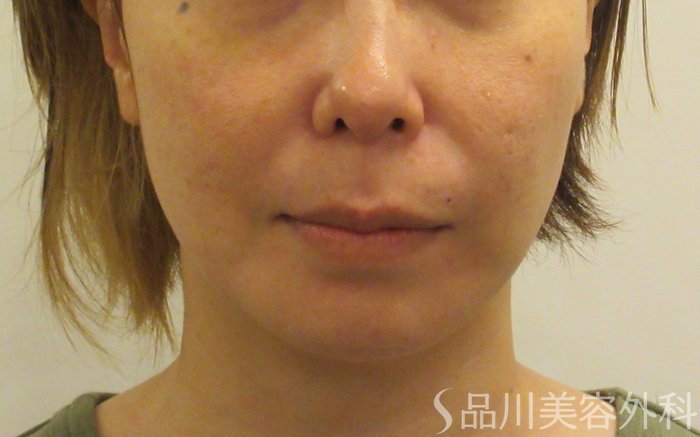 症例NO.71495のBEFORE写真