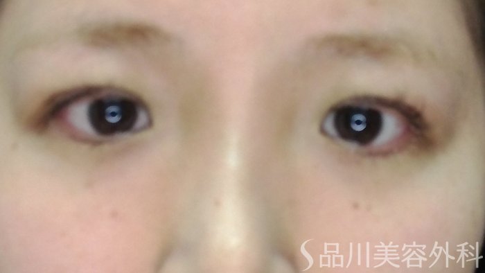 症例NO.71261のAFTER写真