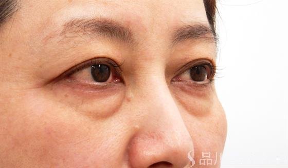 症例NO.53421のBEFORE写真