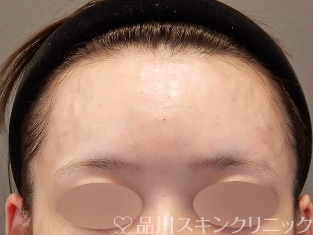 症例NO.75351のAFTER写真