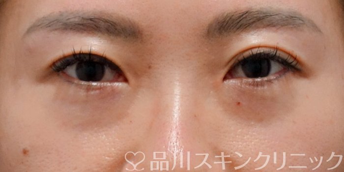 症例NO.73388のBEFORE写真