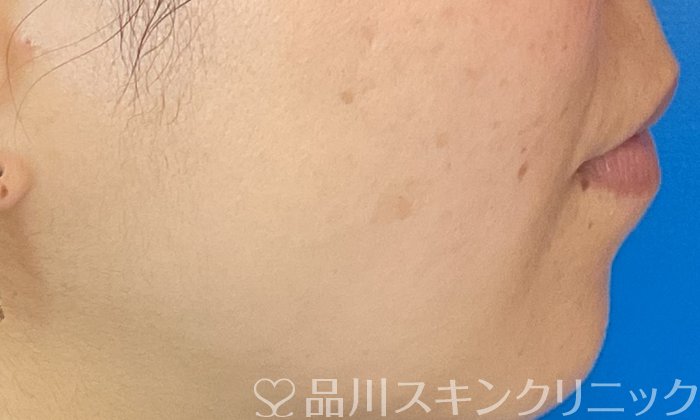 症例NO.73743のAFTER写真