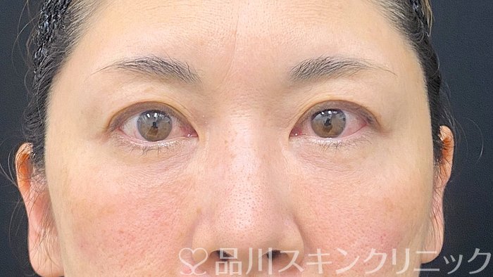 症例NO.74278のAFTER写真