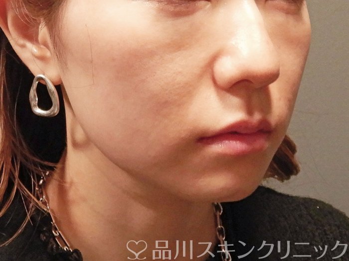 症例NO.62409のBEFORE写真