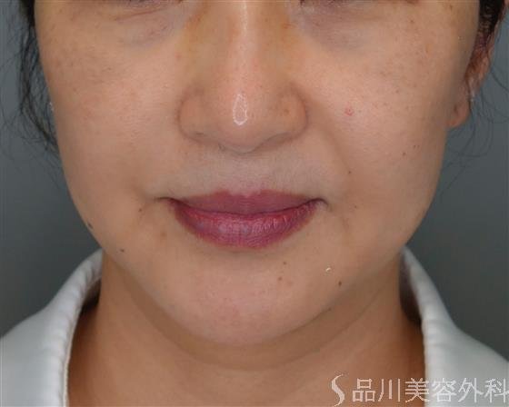 症例NO.50941のBEFORE写真