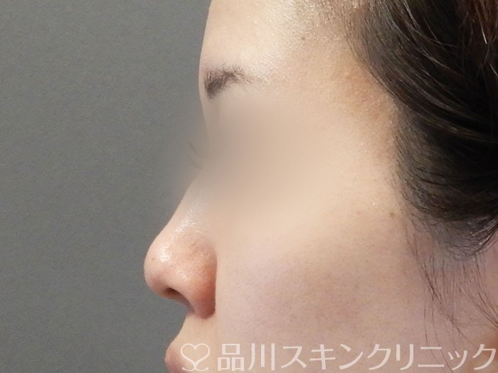 症例NO.65320のBEFORE写真