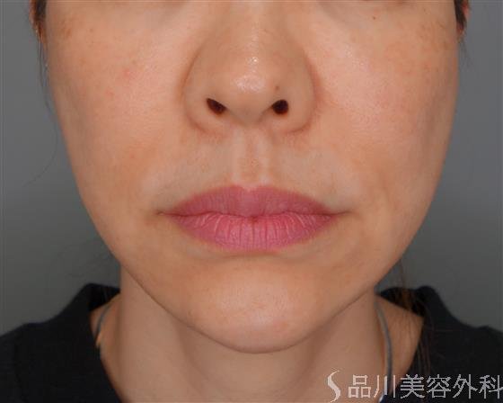 症例NO.53472のBEFORE写真