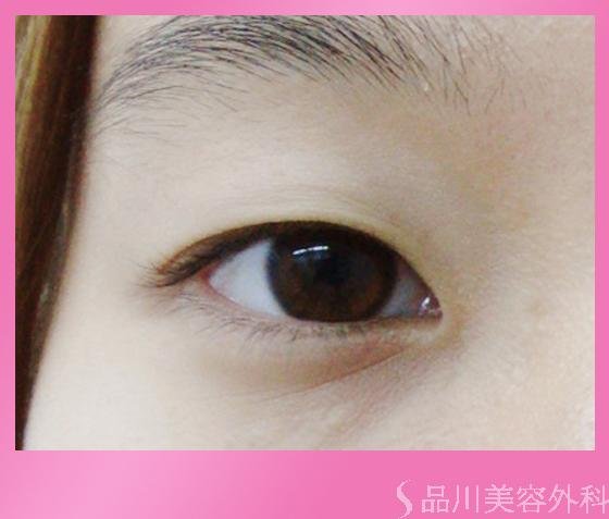 症例NO.822のBEFORE写真