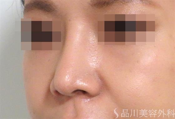 症例NO.35704のAFTER写真