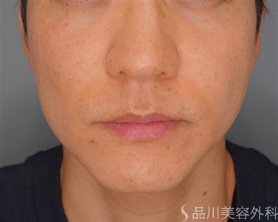 症例NO.53173のBEFORE写真