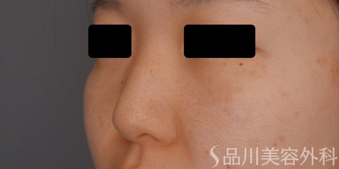 症例NO.64754のBEFORE写真