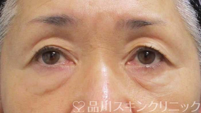 症例NO.69941のBEFORE写真