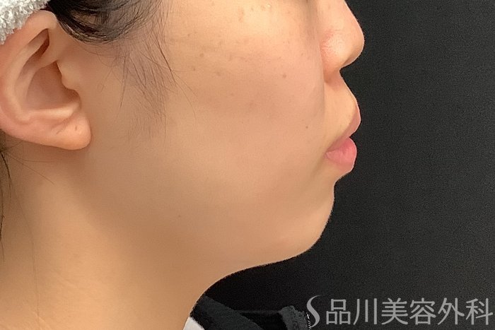 症例NO.71585のBEFORE写真