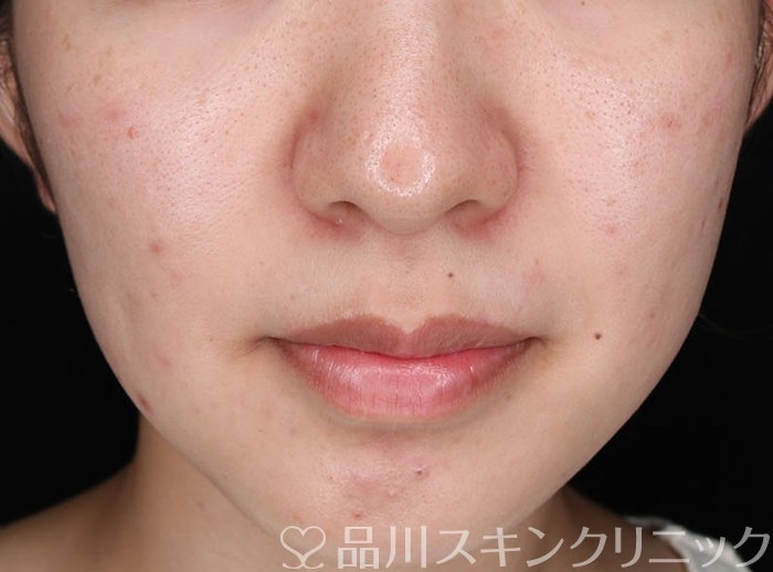 症例NO.70938のBEFORE写真