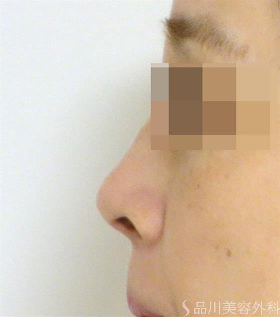 症例NO.44136のAFTER写真