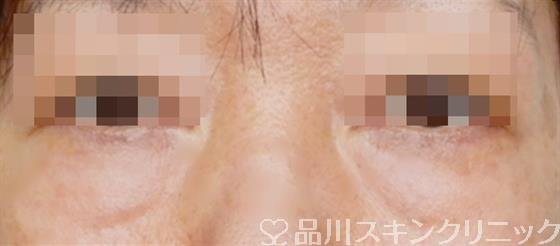 症例NO.54985のBEFORE写真