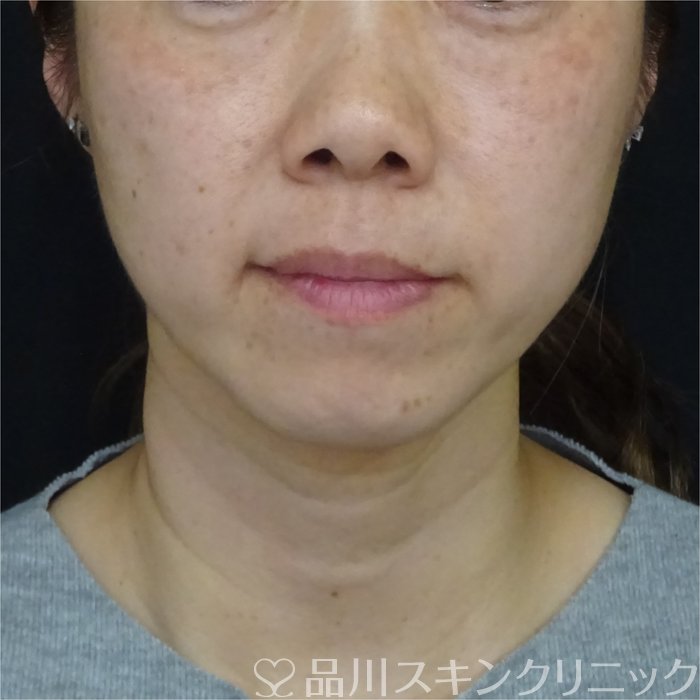 症例NO.69321のBEFORE写真