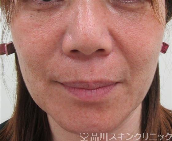 症例NO.30748のBEFORE写真