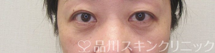 症例NO.69972のAFTER写真