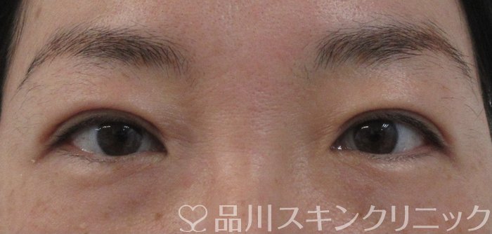症例NO.65653のAFTER写真