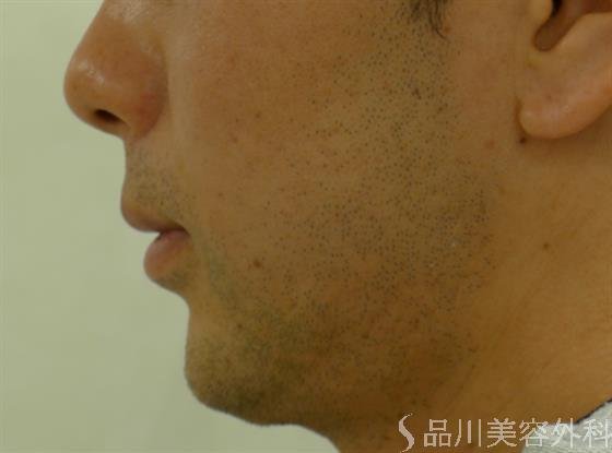 症例NO.34163のAFTER写真