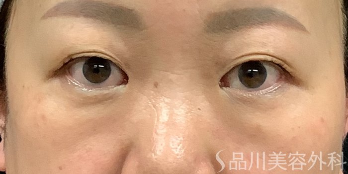 症例NO.71236のBEFORE写真